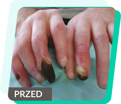 Laserobaria casy study rany na palcach u dłoni przed sesją